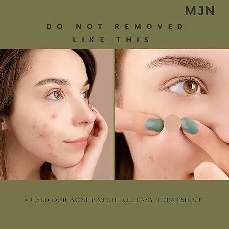 Acne Clearing Pimple Patches