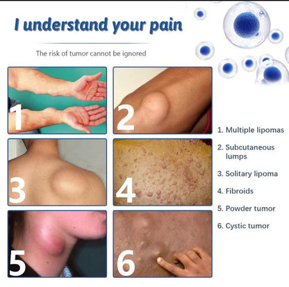 Doctor's No 1 choice | Lipoma Removal Cream (Pack of 2)