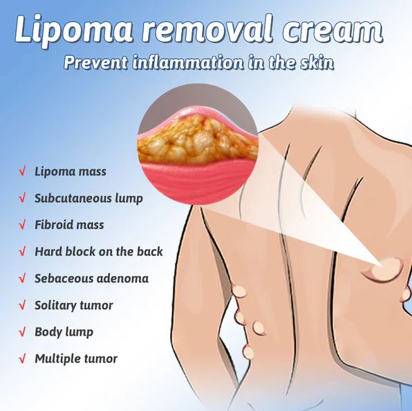 Doctor's No 1 choice | Lipoma Removal Cream (Pack of 2)