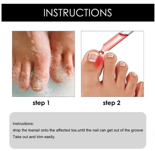 Ingrown Toenail Drops 60 ml Pack of 2