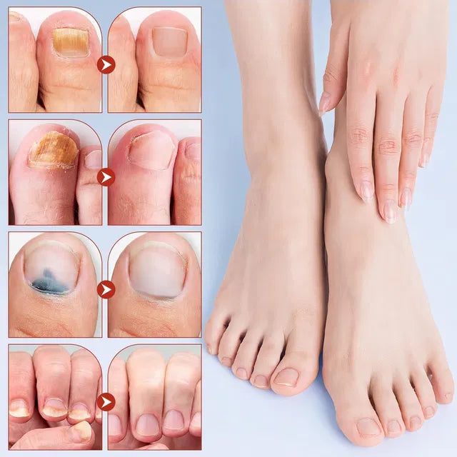 Advanced Fungal Nail Patch. 21 Patches (Pack of 1)